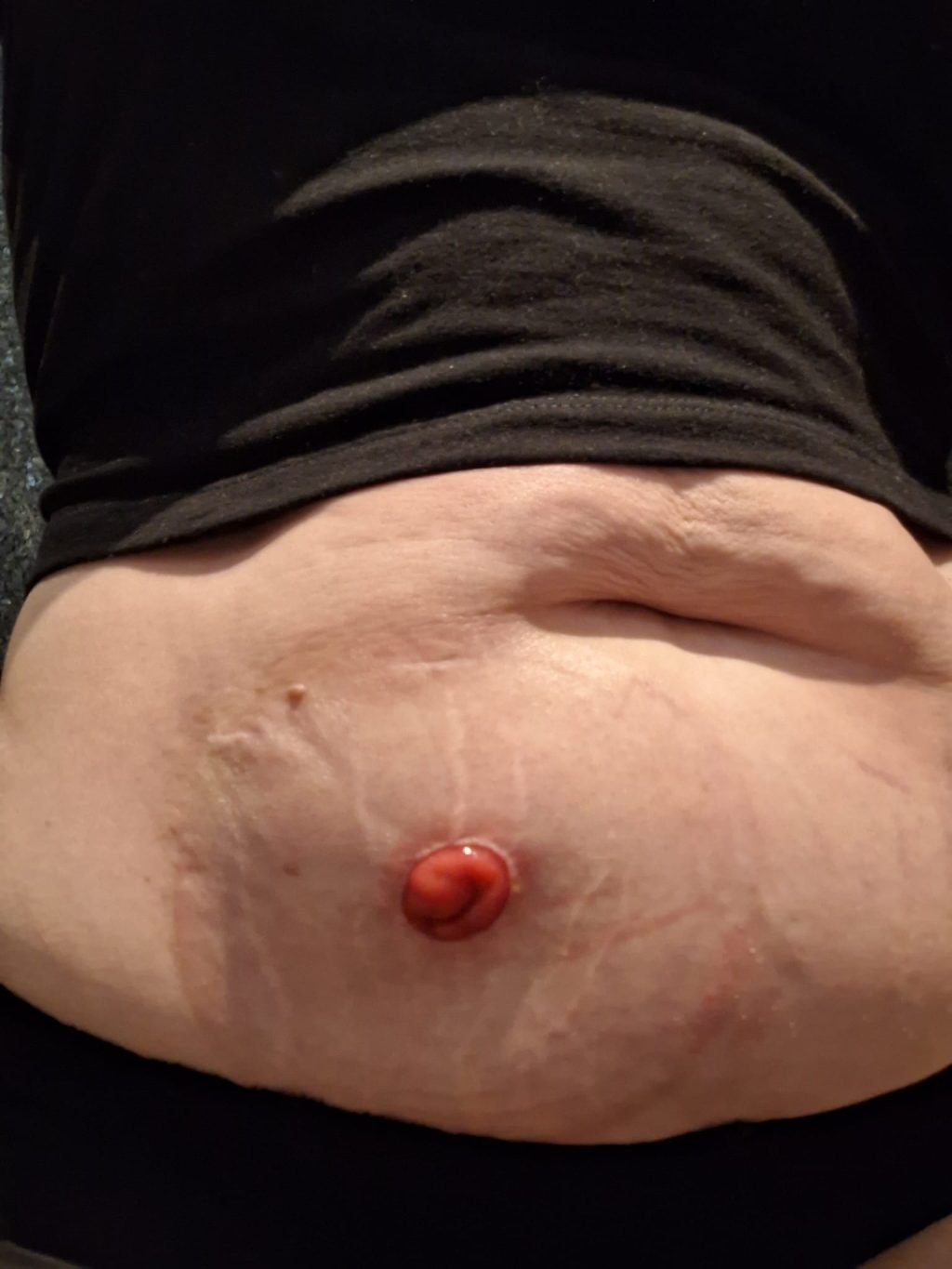 Informatieve avond over darmkanker en stomazorg in Ugchelen